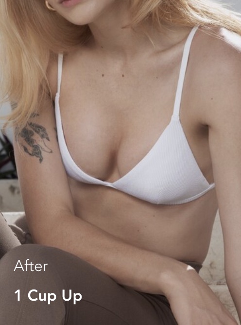 minimalinvasive Brustvergrößerung Mia mit einer Körbchengröße größer