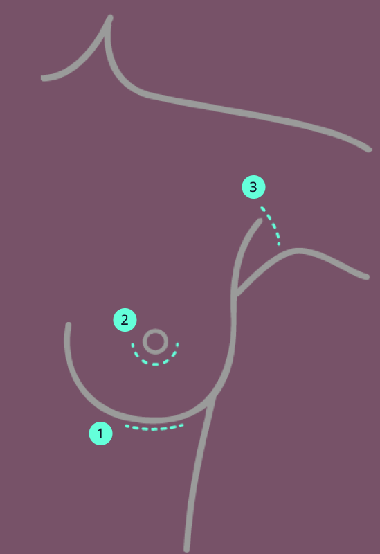 Dieses Foto zeigt verschiedene Schnittf&uuml;hrungen einer Brust-OP.